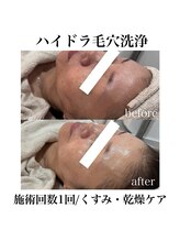 サラ/ハイドラ毛穴洗浄