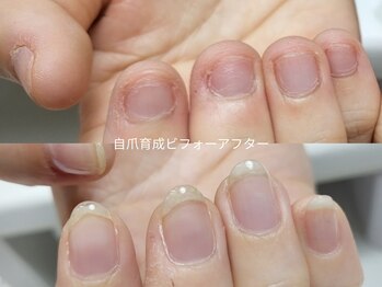 ミンスネイル(Mins Nail)/自爪育成ビフォーアフター