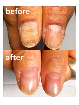 自爪育成/深爪ケア/自爪育成ケア