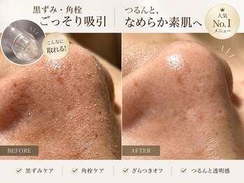 シイ(total skin beaute sii)の写真/大人気♪【黒ずみイチゴ鼻改善】詰まった毛穴汚れを徹底吸引★至近距離で見られてもOKな自信ある素肌へ！