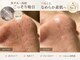 シイ(total skin beaute sii)の写真/大人気♪【黒ずみイチゴ鼻改善】詰まった毛穴汚れを徹底吸引★至近距離で見られてもOKな自信ある素肌へ！