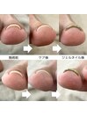 巻き爪ケア専用ジェルネイル
