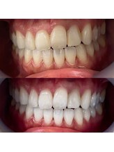 ハク 南船橋店(HAKU)/☆ホワイトニング☆事例写真３