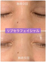 プリュネル(Prunelle)/プラズマシャワー