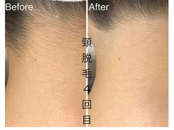 CDF 赤坂/上半身脱毛４回目初回5500