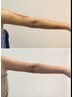 【術後◎二の腕】ほっそりラインづくり早期回復インディバ50分