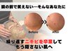 ◎【繰り返すニキビ、赤み、凸凹に】ニキビケアプログラム一回体験20,000円→