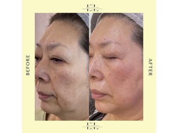 リリィココ(Lily coco.)/ExoLift/エクソリフト