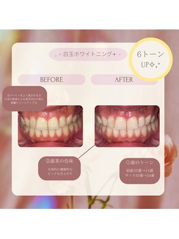 プラスビーセルフ(+b self)/ホワイトニングビフォーアフター