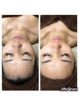 キャルティ(CALTY)/剥離なしALEXハーブピーリング