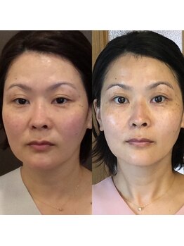 たかはし治療院/美容鍼 10回の結果です