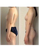 モア(moa)/5回目症例