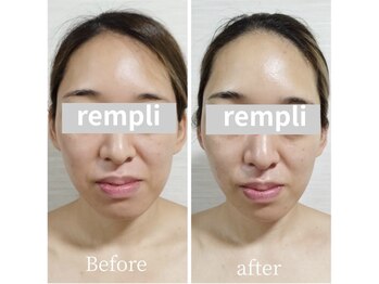 ランプリール 学芸大学(rempli)/【小顔矯正もできるサロン♪】