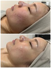 リノ レイ(Lino Ray)/【水光ピーリング・毛穴洗浄】