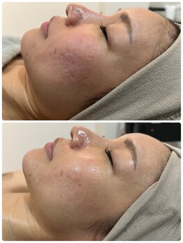 リノ レイ(Lino Ray)/【水光ピーリング・毛穴洗浄】