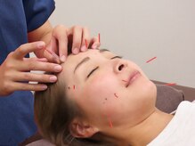 アクア治療院 伏古/SNS話題の美容鍼♪