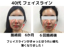 エンジェルエッグ/◆フェイスラインがシャープに！