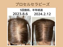 【頭皮ケア】プロセルトリートメント