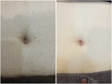 レイズ(RAISE)/メンズ脱毛　お腹