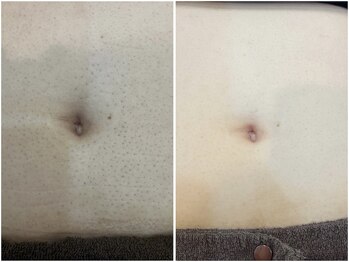 レイズ(RAISE)/メンズ脱毛　お腹