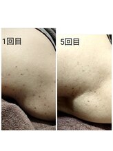 サロン ピューパ(Salon pupa)/シミケアBefore→After