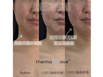 アンドエスビューティ(&S Beauty)/オンダリフト同等出力!!