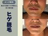 【メンズ脱毛】 ヒゲ脱毛(小鼻洗浄付)毎日の手間なし!老け顔卒業 ¥3300