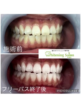 ホワイトニングサロン 札幌店/【ホワイトニング】#札幌#大通り