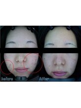 ザ フェース 京都御池店(THE FAITH)/お客様の肌変化