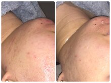 ポノ(PONO)/肌荒れが気になる方へ