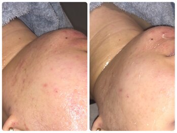 ポノ(PONO)/肌荒れが気になる方へ