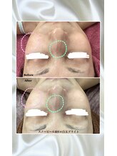 プリマプリート 各務原店/乳酸ピール3回