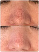 シャイン(Shine)/すり鉢毛穴の改善