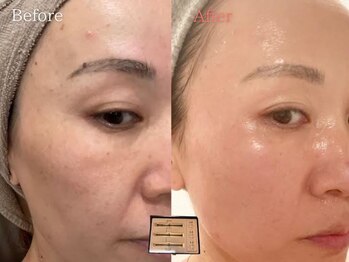 ミューズファクトリー(Muse factory)/韓国式肌質改善ができる！