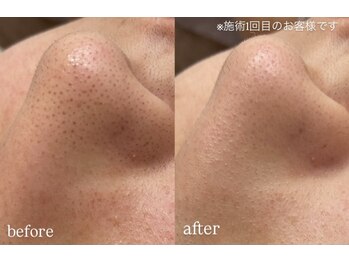 イルナ(ILUNA)/毛穴洗浄！ハイドロスキン