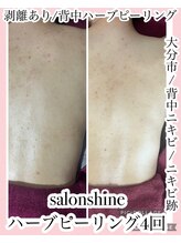 サロンシャイン(Salon Shine)/背中ハード