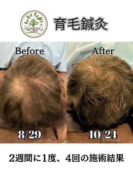 ケヤキ(KEYAKI)/育毛を促進する鍼灸施術