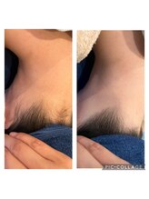 ロア(ROA)/一度でスッキリ！ワックス脱毛