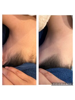 ロア(ROA)/一度でスッキリ！ワックス脱毛