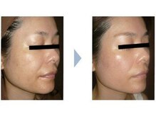 ビューティースパ/小顔/リフトアップ/たるみケア