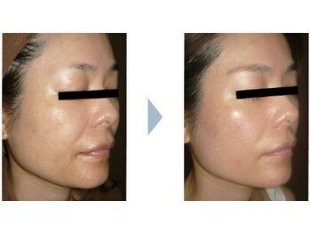 ビューティースパ/小顔/リフトアップ/たるみケア