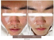 ポアレ 高崎店(POALE)/毛穴ケア症例【群馬/高崎】