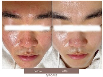 ポアレ 高崎店(POALE)/毛穴ケア症例【群馬/高崎】