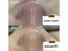 ルミエール パークサイド(L’MIERE parkside)の雰囲気（20代後半,黒ずみと詰まりで来店。施術3回で毛穴が目立たない素肌）