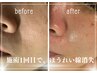 【全身ケア】美容鍼＋身体の鍼灸＋フェイシャルエステ＋オイルトリートメント