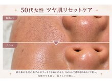 フラワー(FLOWER)/50代女性　ツヤ肌リセット 1回目