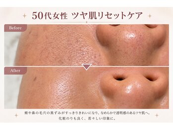 フラワー(FLOWER)/50代女性　ツヤ肌リセット 1回目