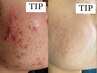 【本気のニキビケア】自然に剥けるＴＩPハーブピーリング