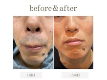 エントランス(Entrance)の雰囲気(ヒゲ脱毛で毎日のヒゲ剃りから解放!青ひげなくして若々しく!)