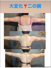 パウザ(PAUSA)/脂肪冷却ダイエット